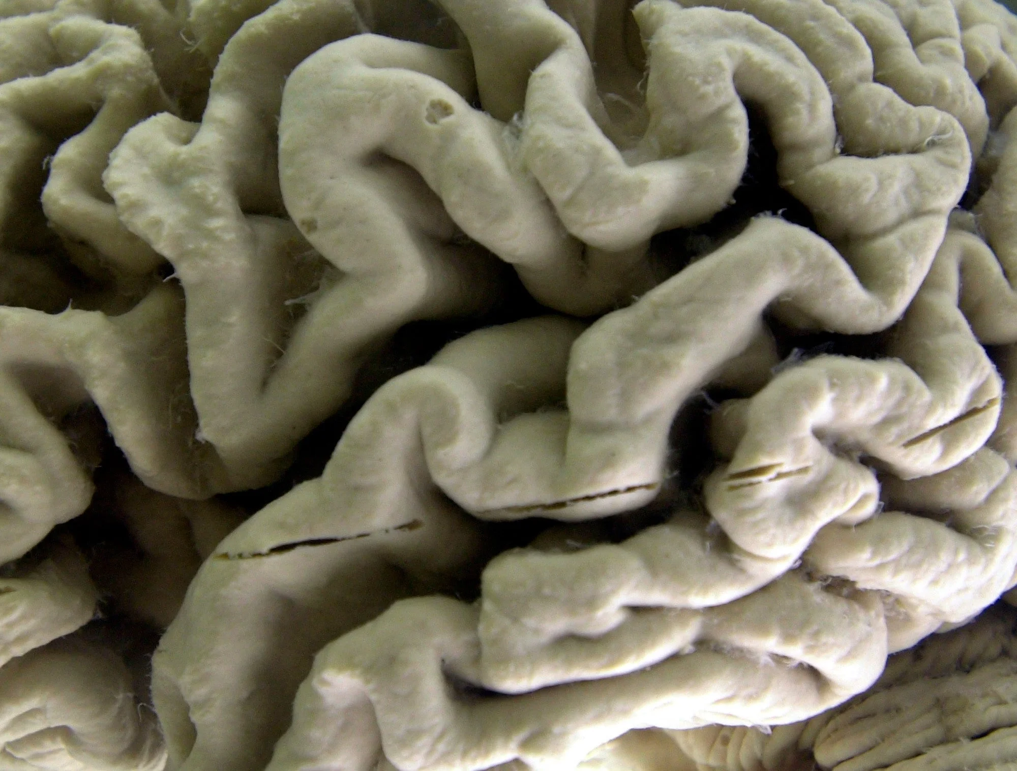 A human brain affected by Alzheimer's disease is displayed at the Museum of Neuroanatomy at the University at Buffalo