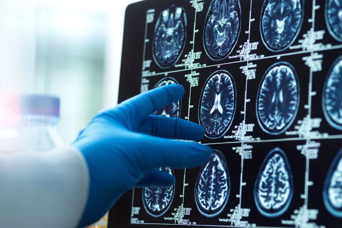 Metabolic Syndrome Linked to Accelerated Brain Aging in Adults